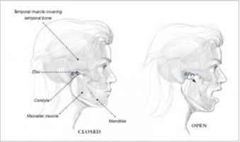 TMJ pain diagram